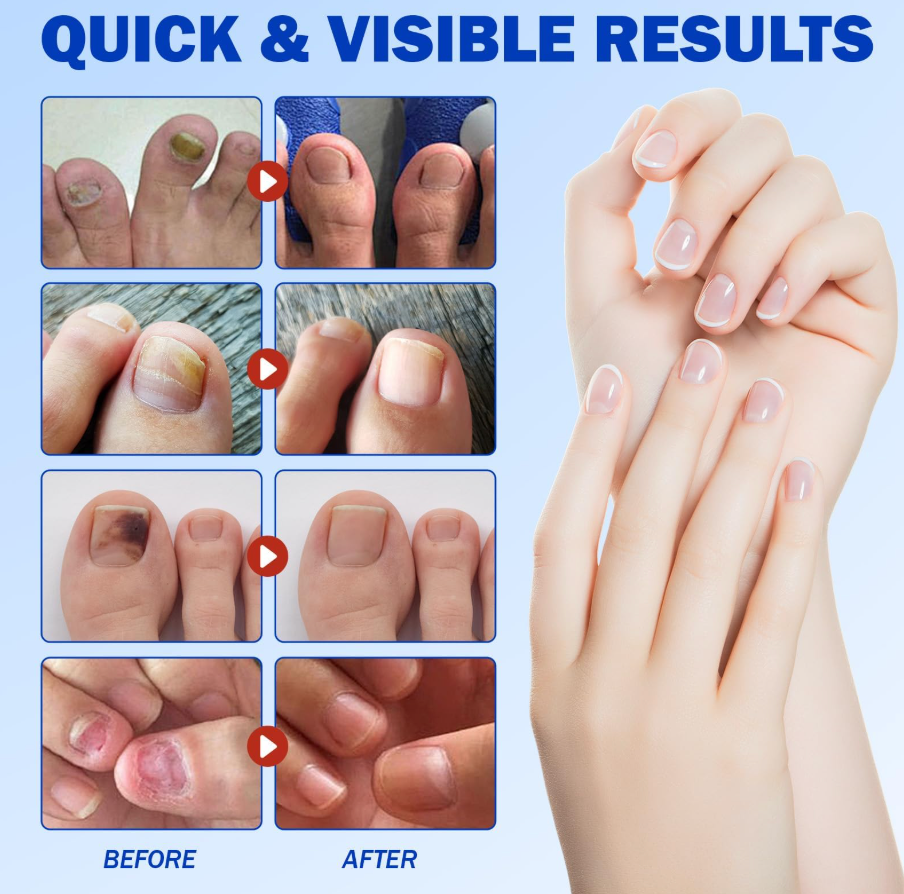 Fungus Nail Patches